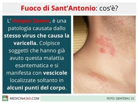 fuoco di sant'antonio quanto dura.